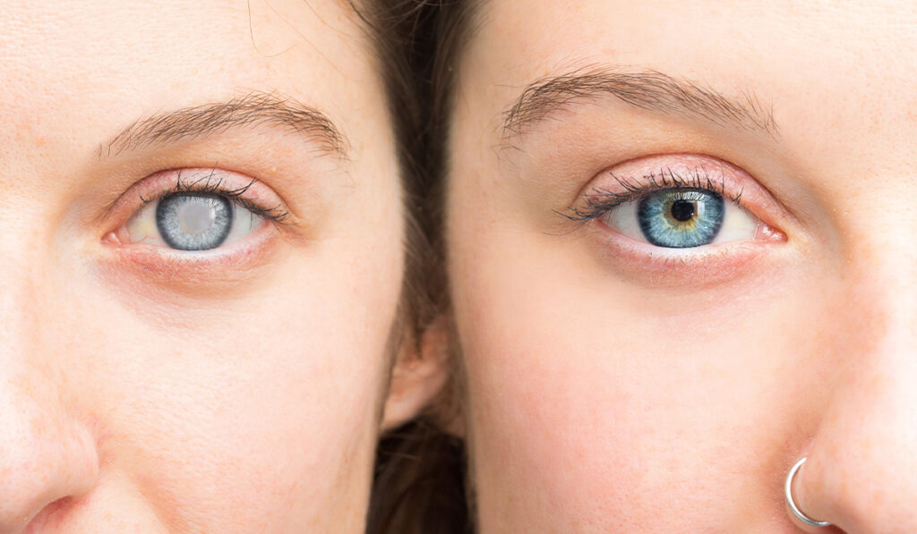 اعراض المياه البيضاء