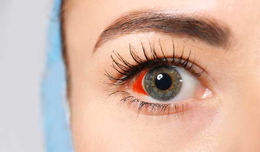 النزيف الزجاجي للعين