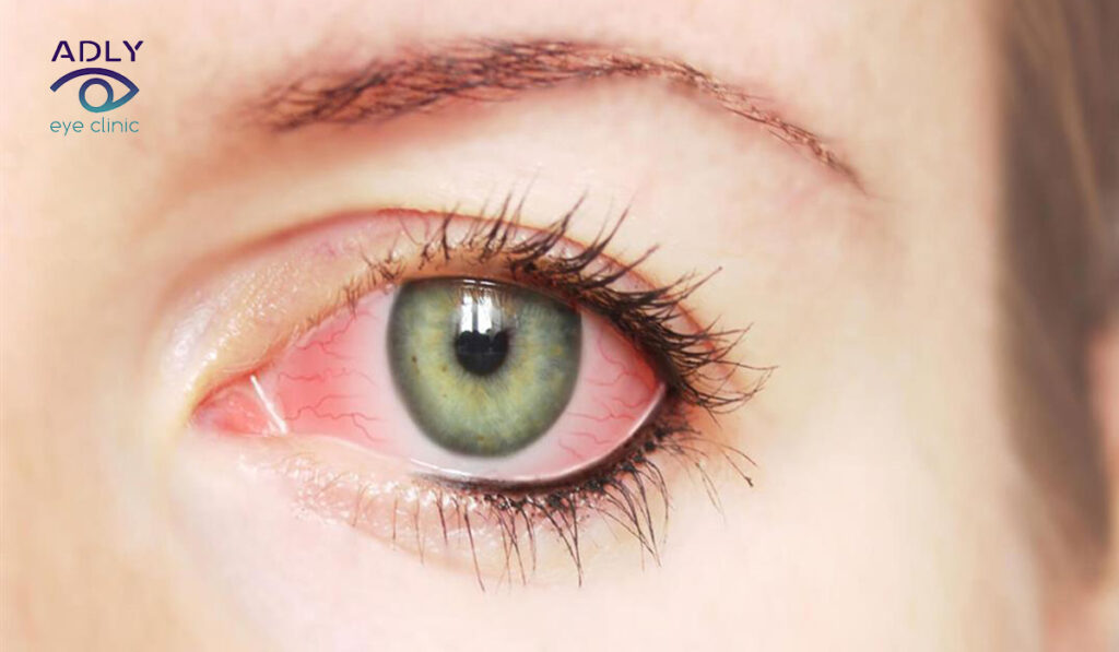 المياه البيضاء