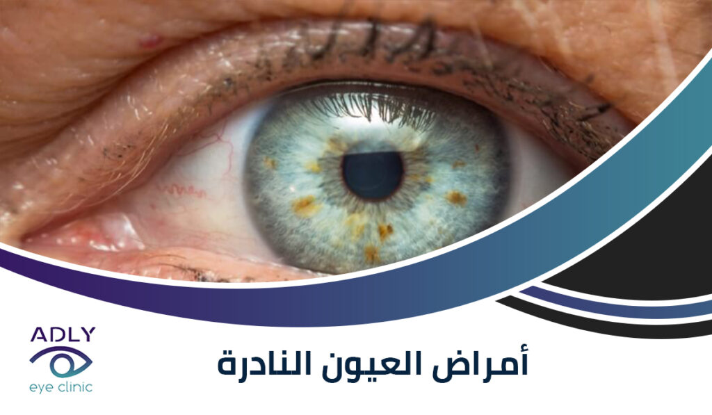 أمراض العيون النادرة