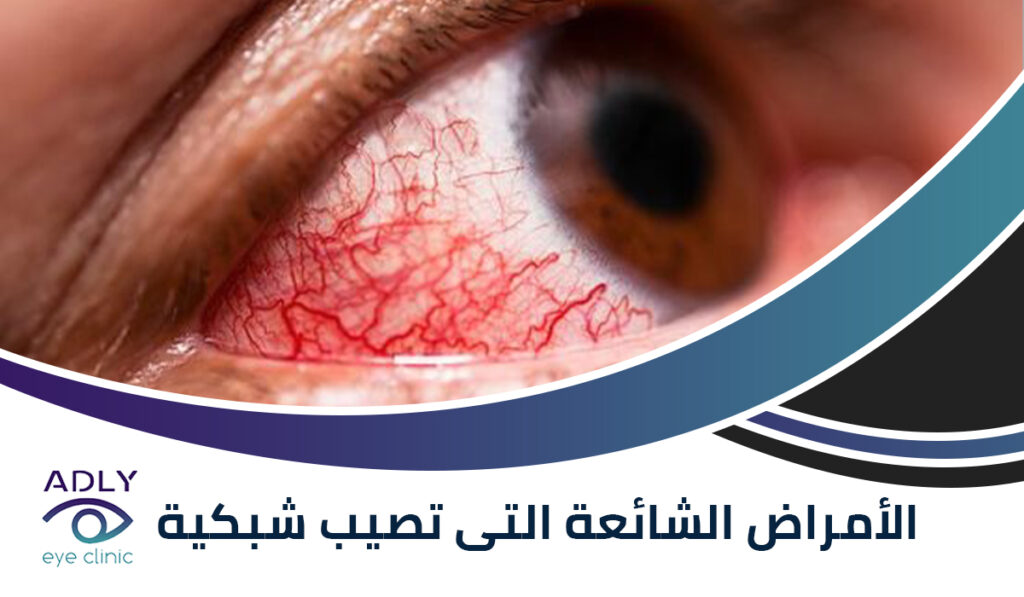 الأمراض الشائعة التى تصيب شبكية