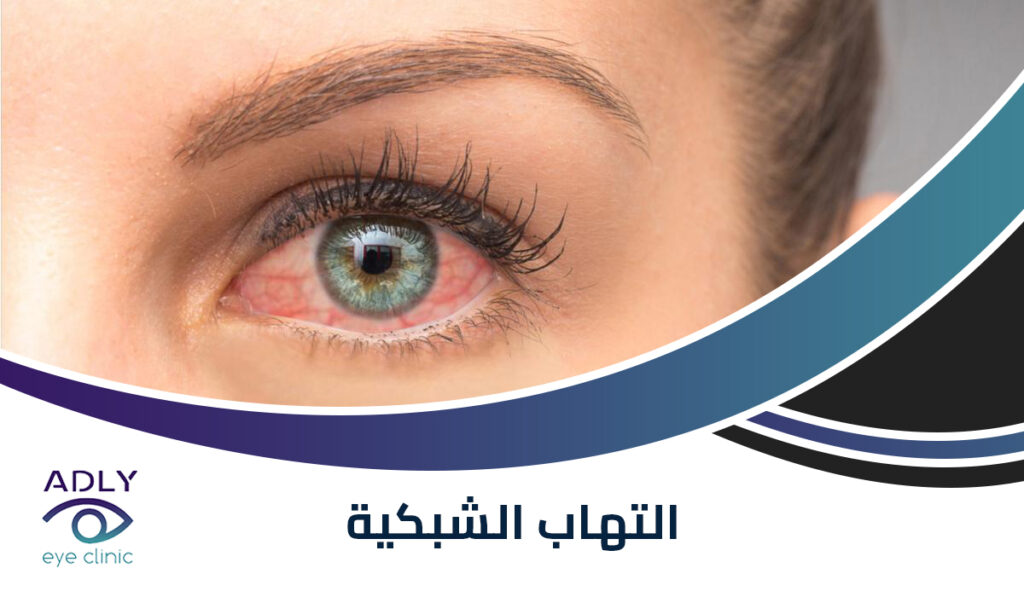 التهاب الشبكية الصباغى