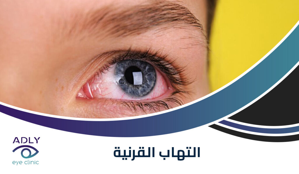 التهاب القرنية