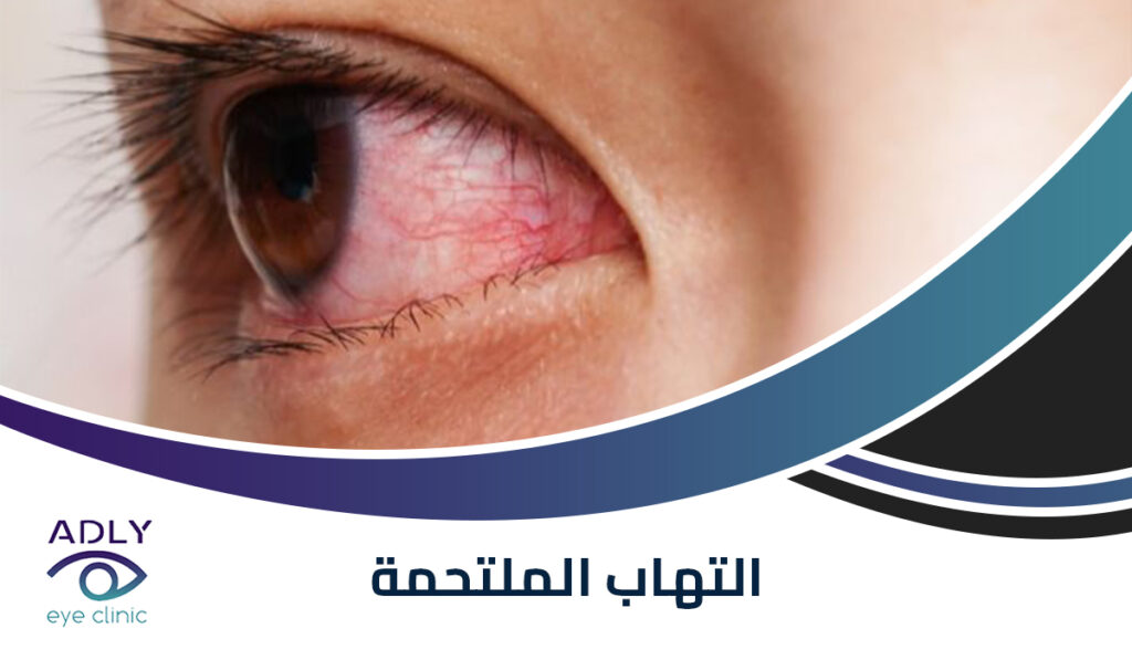 التهاب الملتحمة