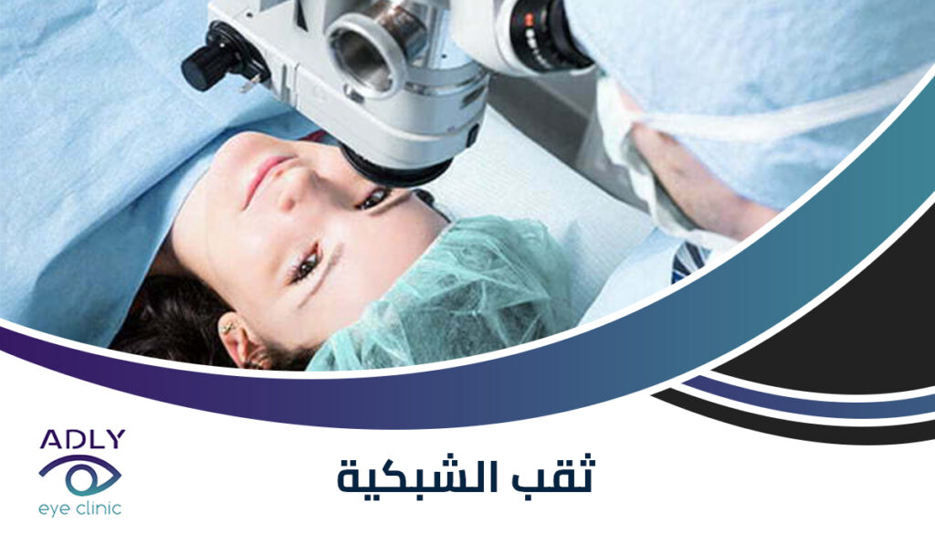 ثقب الشبكية